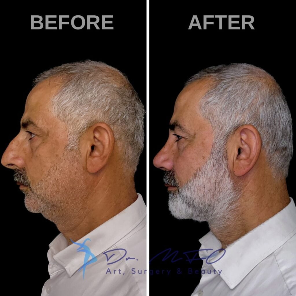 Comparación antes y después de un procedimiento de restauración capilar realizado en un paciente masculino con canas