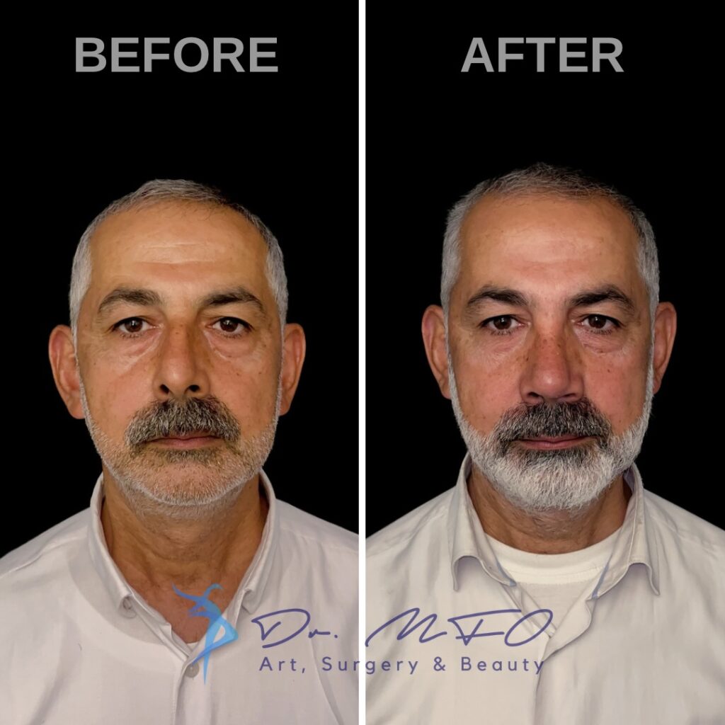 Facial Masculinization Surgery Dr. MFO FFS Surgeon in Turkey