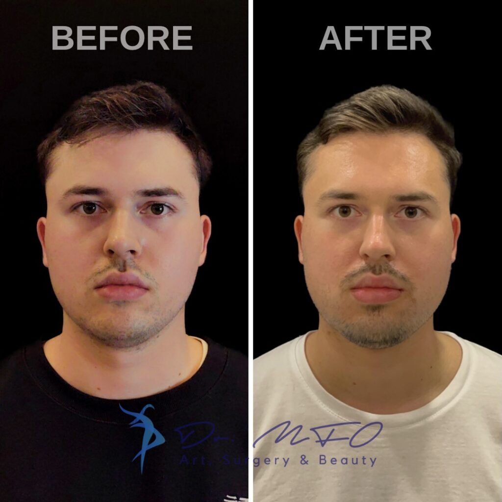 Facial Masculinization Surgery Dr. MFO FFS Surgeon in Turkey