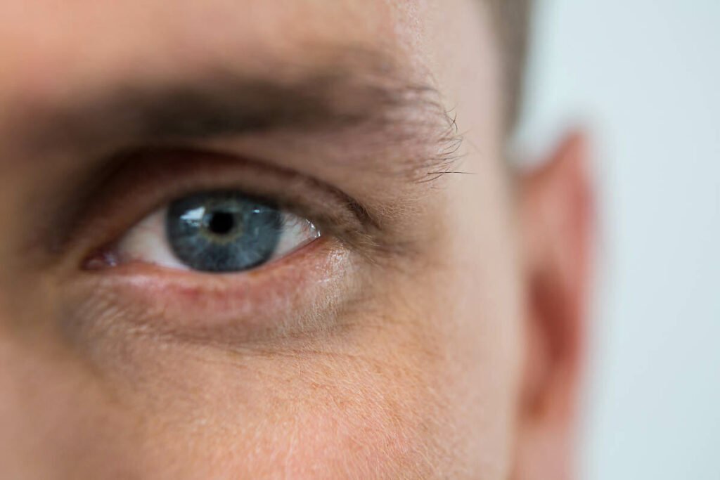 Un primer plano de un ojo azul con signos visibles de enrojecimiento e irritación en el párpado.