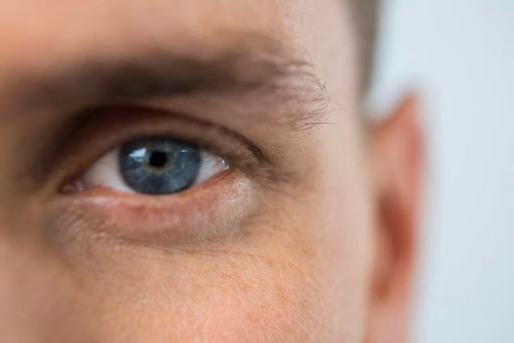 Un primer plano de un ojo azul con signos visibles de enrojecimiento e irritación en el párpado.