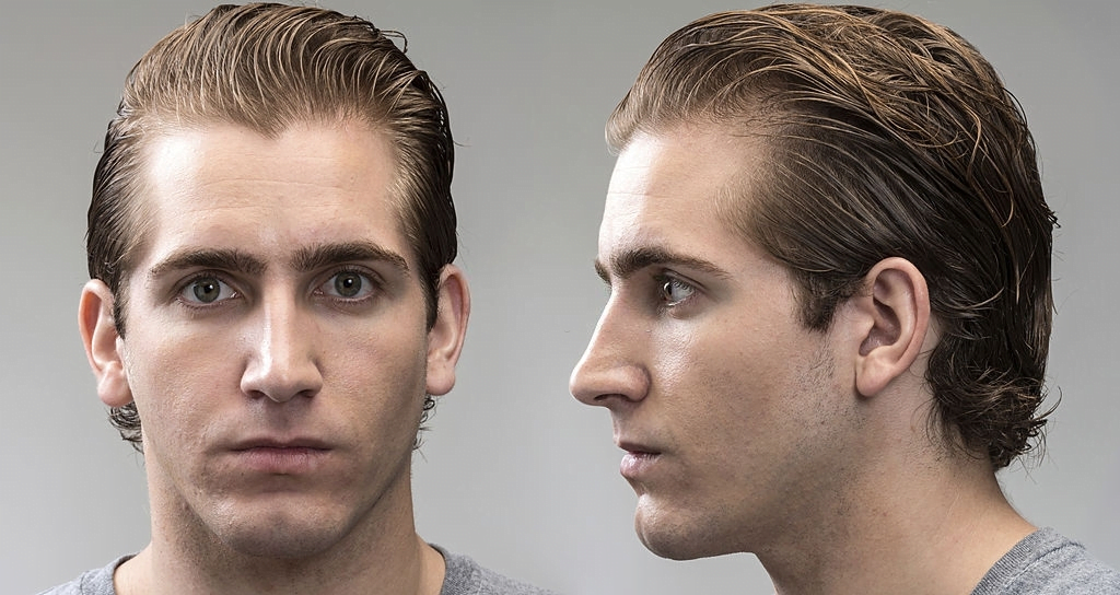 Antalya: Unveiling Your Masculine Potential - A Guide to Facial Masculinization Surgery 1