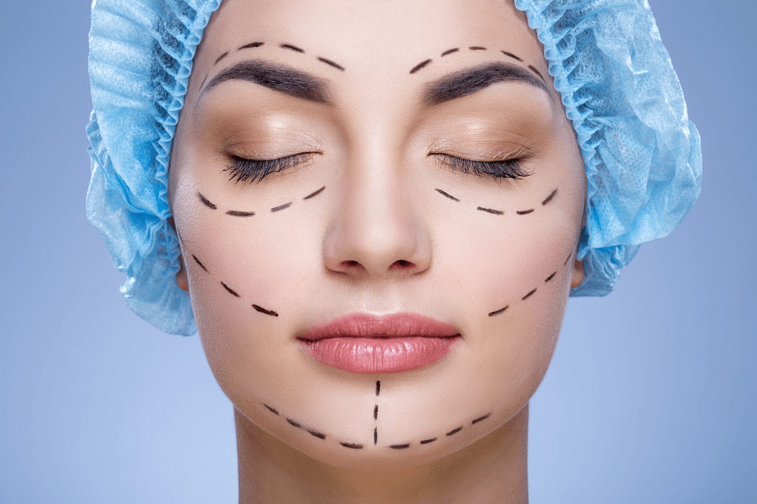 facial feminization surgery ffs