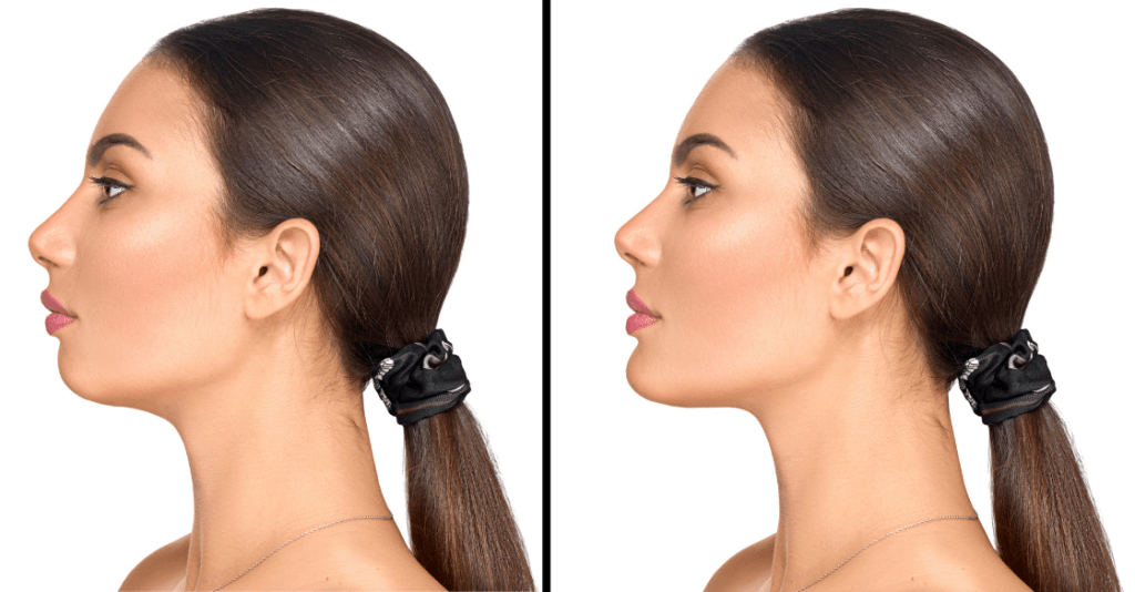 Facial Feminization Surgery: A Guide for Transgender Women 2