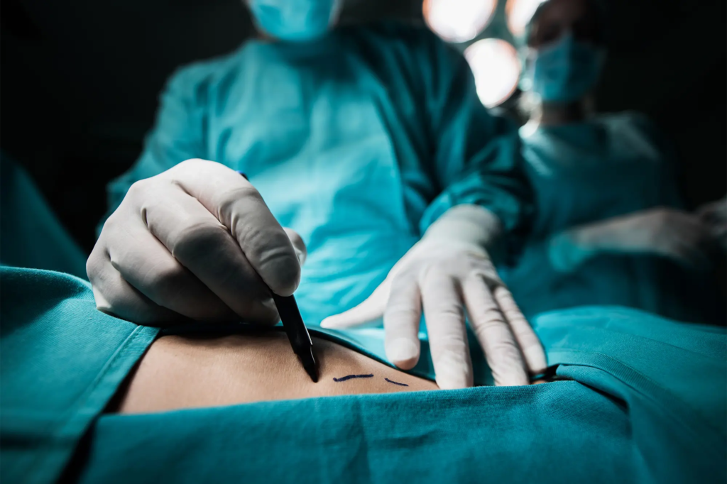 A close-up image of a surgeon's gloved hands carefully making an incision on a patient's abdomen during a surgical procedure, with other medical professionals in surgical attire visible in the background.