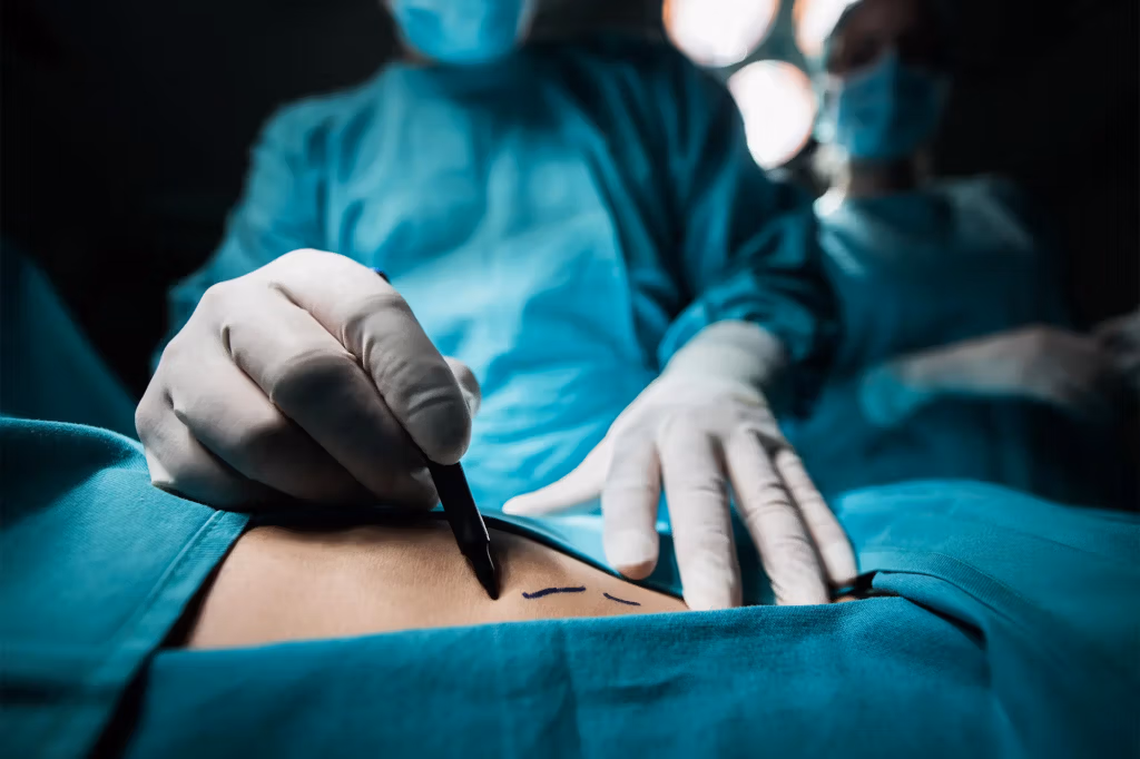 Eine Nahaufnahme der behandschuhten Hände eines Chirurgen, der während eines chirurgischen Eingriffs vorsichtig einen Schnitt am Bauch eines Patienten vornimmt. Im Hintergrund sind andere medizinische Fachkräfte in OP-Kleidung zu sehen.