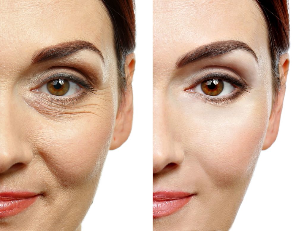 ¿Qué es un lifting de ojos Madonna? 3