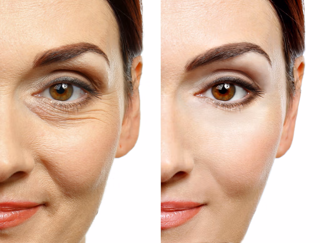 Una comparación de antes y después que muestra el área de los ojos de una persona con arrugas y líneas finas visibles a la izquierda (antes), y la misma área con un aspecto más suave y juvenil a la derecha (después), lo que probablemente demuestra los efectos de un tratamiento antienvejecimiento o un producto para el cuidado de la piel.