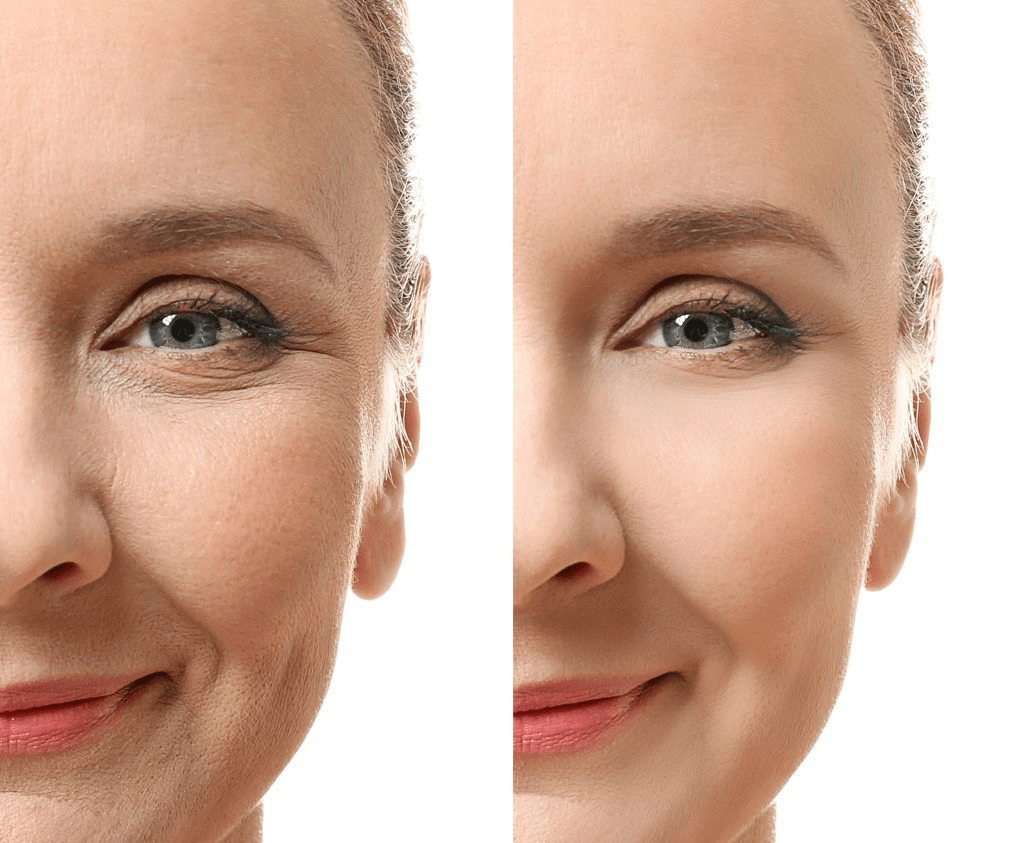 ¿Qué es un lifting de ojos Madonna? 2