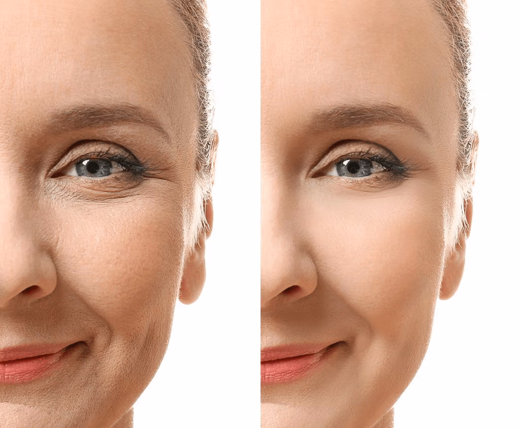Comparación del antes y el después del rostro de una mujer, mostrando los efectos de un procedimiento cosmético, con especial atención a la zona de los ojos y la frente. El lado izquierdo muestra arrugas visibles y signos de envejecimiento, mientras que el lado derecho presenta una piel más tersa, con menos arrugas y una apariencia más juvenil.