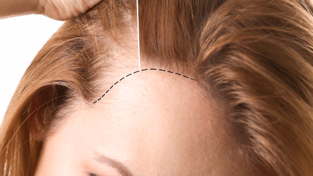 صورة مقرّبة لفروة رأس شخص مع سحب جزء من الشعر للخلف، مما يكشف عن خط الشعر. رُسم خط أسود متقطع على فروة الرأس، يشير إلى منطقة تستدعي الاهتمام أو التركيز، ربما تكون مرتبطة بتساقط الشعر أو إجراء طبي.
