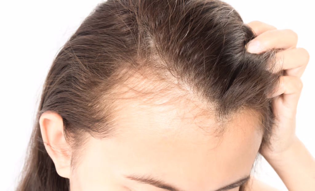 ¿Es normal la línea del cabello en forma de M?