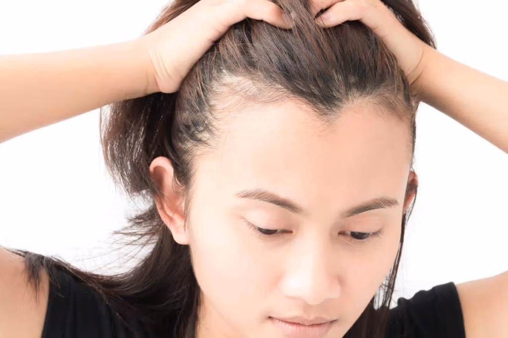 ¿Es normal la línea del cabello en forma de M?
