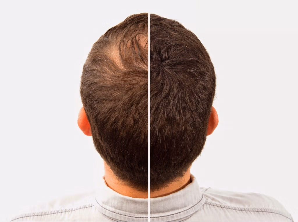 Before-and-after comparison showing hair restoration. The left side displays thinning hair or balding on the top of the head, while the right side shows thicker and fuller hair after treatment.