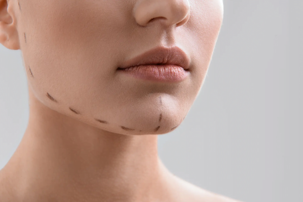 A close-up image of a person's face with dotted lines marking the chin and neck area, suggesting preparation for a cosmetic procedure.
