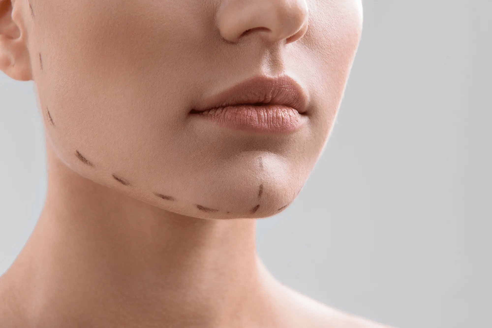 A close-up image of a person's face with dotted lines marking the chin and neck area, suggesting preparation for a cosmetic procedure.