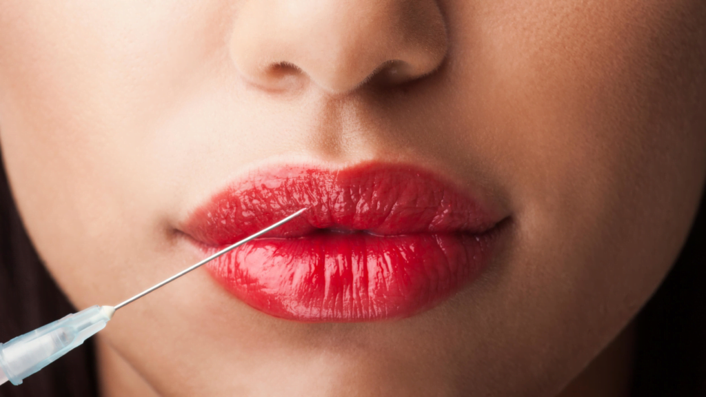 Do Lip Fillers Go Away? A Comprehensive Guide 5