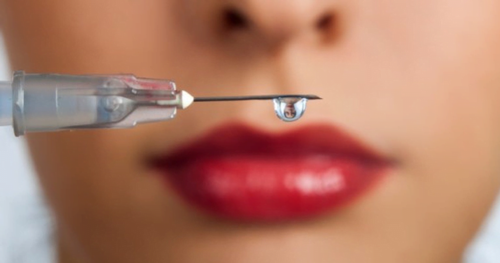 Do Lip Fillers Go Away? A Comprehensive Guide 1