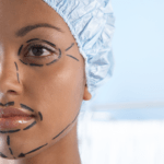 A person wearing a surgical cap with pre-operative markings on their face, likely preparing for a cosmetic procedure.
