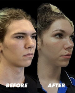 Ein Vorher-Nachher-Vergleich einer Gesichtsfeminisierungsoperation, der das Seitenprofil des Gesichts einer Person mit auffälligen Veränderungen der Gesichtsstruktur zeigt.