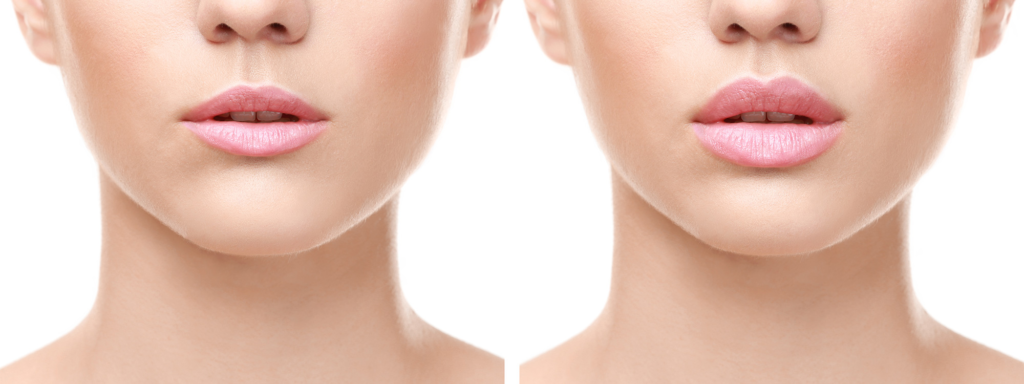 Aumento de labios: todo lo que necesita saber para mejorar su sonrisa 2