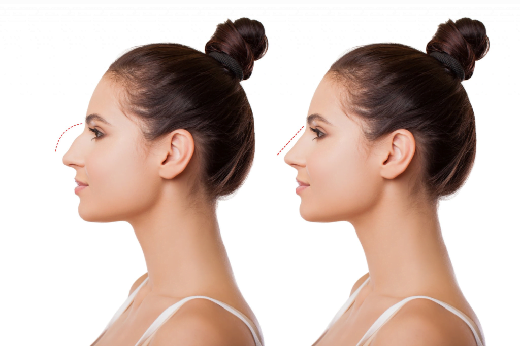 Unveiling Your Best You: Exploring Nose Surgery in Turkey 2
