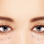 Photo du visage d'une femme avec des marques préopératoires autour des yeux