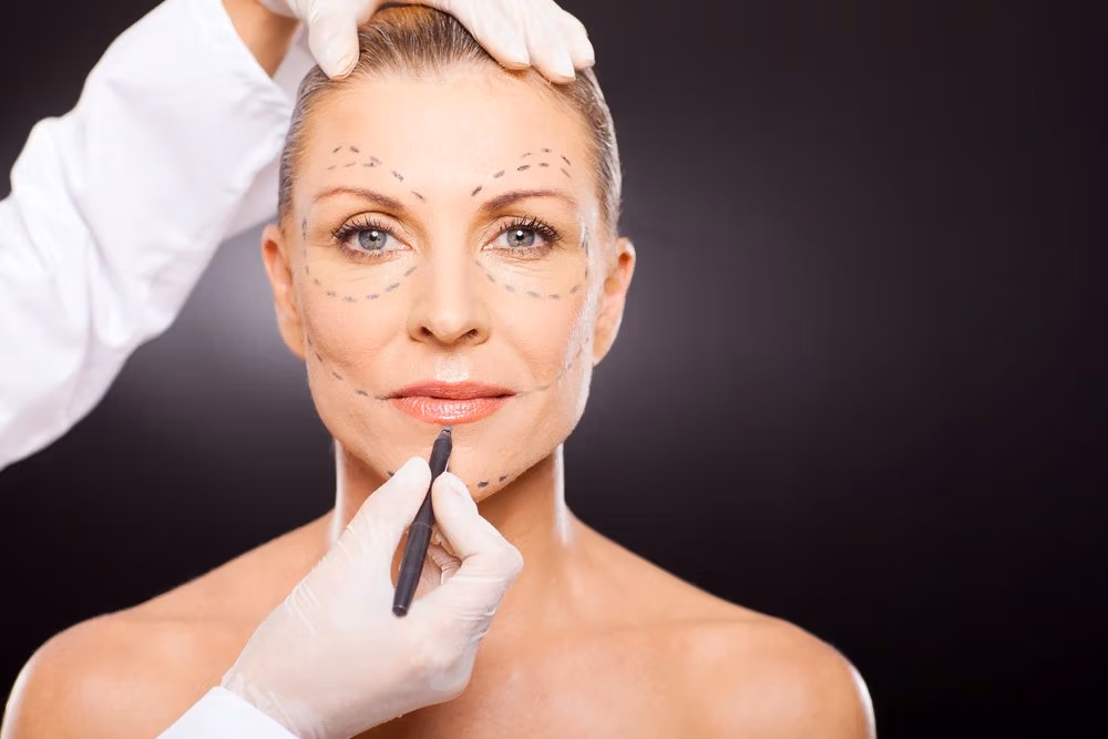 Un professionnel de santé en gants blancs marque le visage d'une femme au stylo, se préparant probablement à une intervention esthétique. Des lignes sont dessinées sur son visage, indiquant les zones à traiter.
