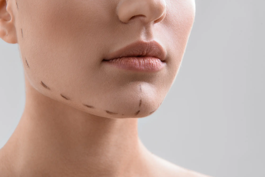 Lograr la armonía facial: explorar los beneficios de la cirugía Vline 1