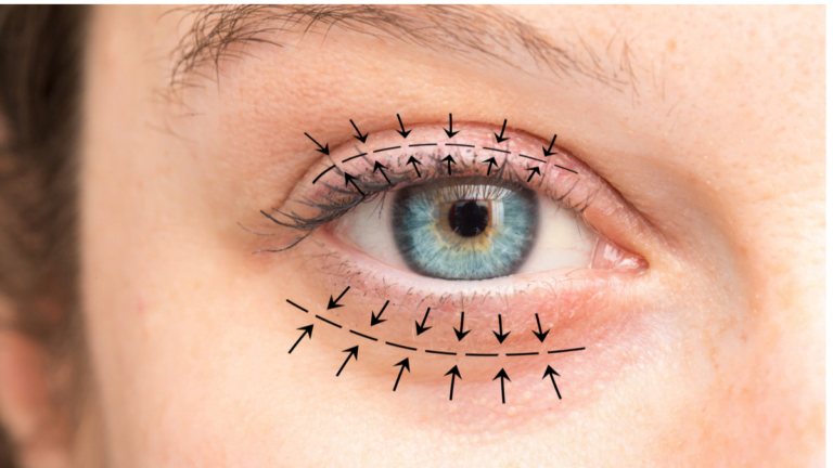 Diagrama que muestra áreas para corrección quirúrgica por encima y por debajo del ojo, con flechas que indican regiones específicas para procedimientos de blefaroplastia superior e inferior.