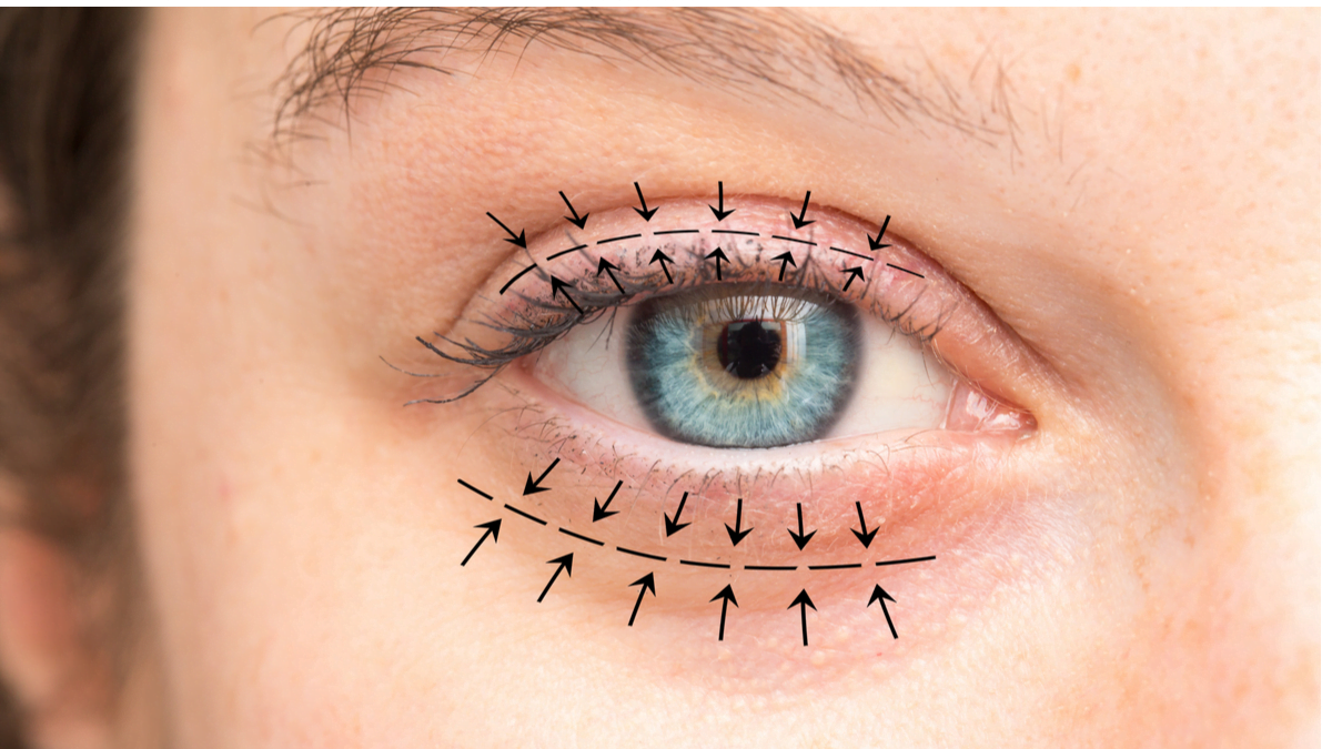 رسم تخطيطي يوضح مناطق التصحيح الجراحي أعلى وأسفل العين، مع وجود أسهم تشير إلى مناطق محددة لإجراءات رأب الجفن العلوي والسفلي.