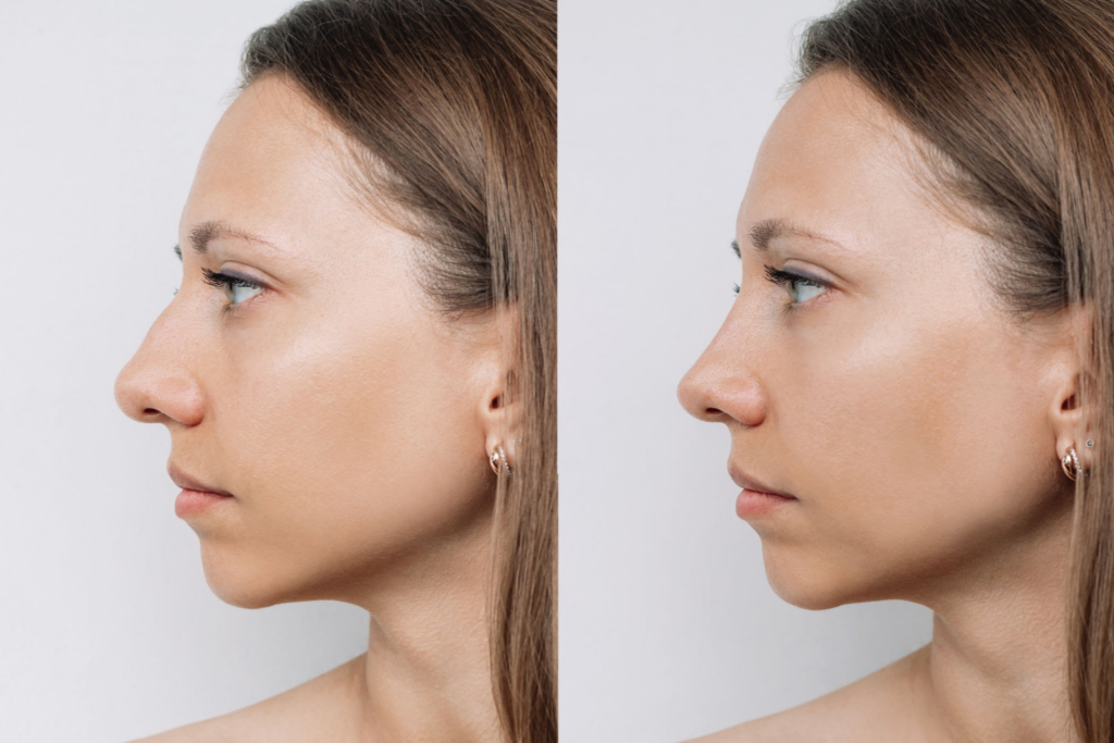 Facial Feminization Surgery: 5 Intriguing Nose Transformations Revealed! 3