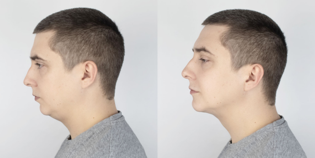 Chin Implant Quandary: Unveiling the Superior Solution for a Sculpted Jawlin 4