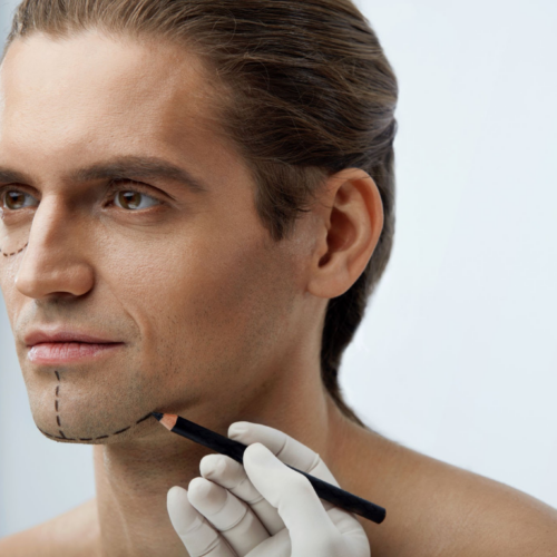 A close-up image of a man's face with a pencil being held near his chin. The man has markings on his face, suggesting preparation for a cosmetic or surgical procedure. The image likely depicts a pre-operative planning session in a medical or cosmetic surgery setting.