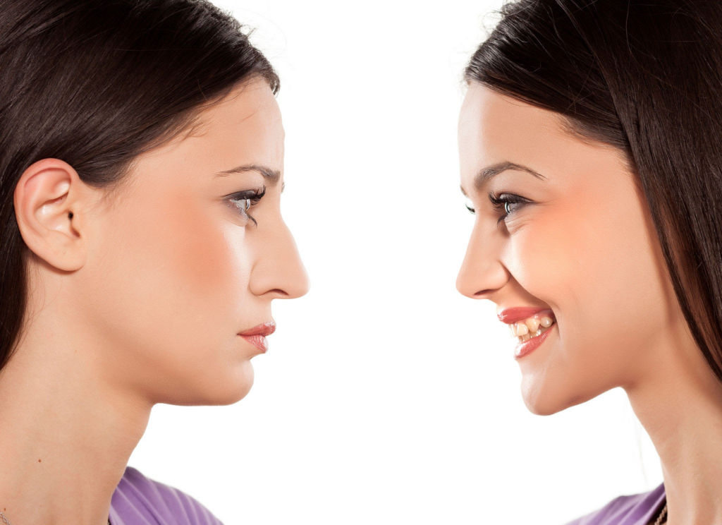 Comparación del antes y el después de una persona sometida a una rinoplastia (cirugía de nariz). El lado izquierdo muestra la nariz original, mientras que el lado derecho muestra la nariz refinada y simétrica después de la cirugía. La persona tiene cabello oscuro y viste una blusa morada.