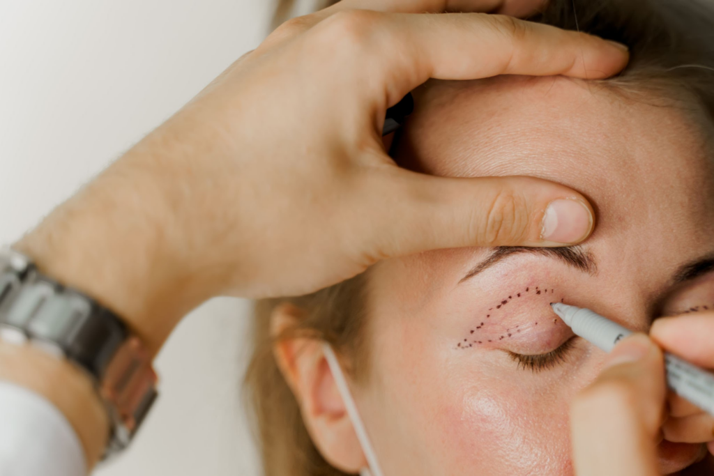 Facial Feminization Surgery: Eyelid Surgery for Trans Beauty 2