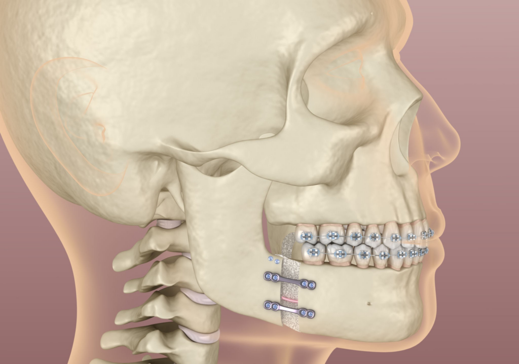 How does mandibular setback surgery contribute to facial feminization?