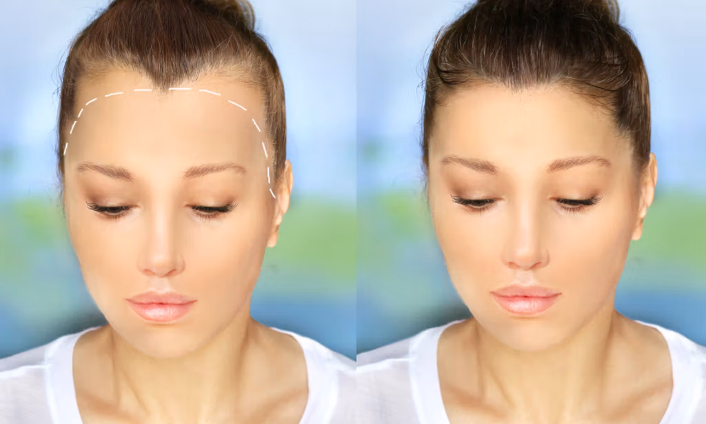 Before and after comparison of forehead reduction surgery, showing a woman with markings on her forehead in the 'before' image and the results in the 'after' image.