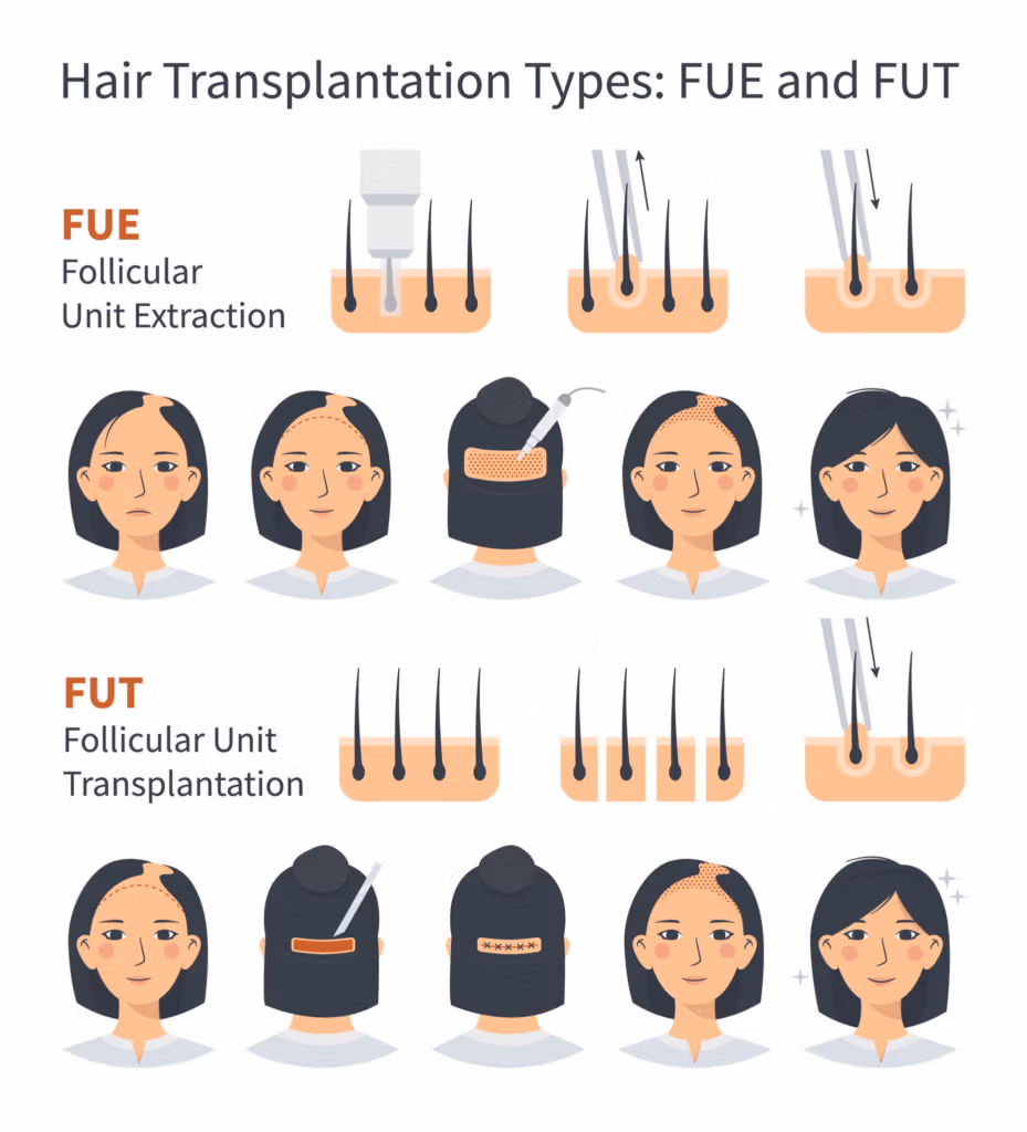 Infographic illustrating two hair transplantation techniques: FUE (Follicular Unit Extraction) and FUT (Follicular Unit Transplantation). FUE shows individual follicles being extracted and transplanted, while FUT depicts the removal of a scalp strip, dissection into follicular units, and transplantation.