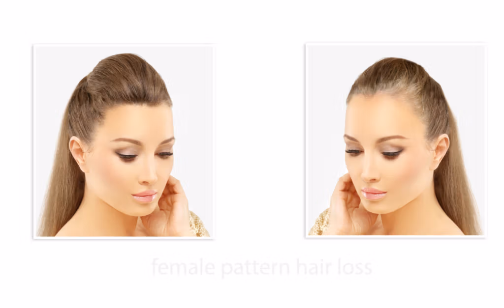 A side-by-side comparison of a woman with and without female pattern hair loss. The left image shows the woman with a full head of hair, while the right image shows the same woman with noticeable thinning at the crown, highlighting the effects of hair loss.