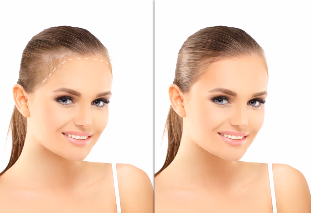 Before and after comparison of a woman's face showing the results of a cosmetic procedure, with white dashed lines indicating treatment areas in the before image and a smoother appearance in the after image.