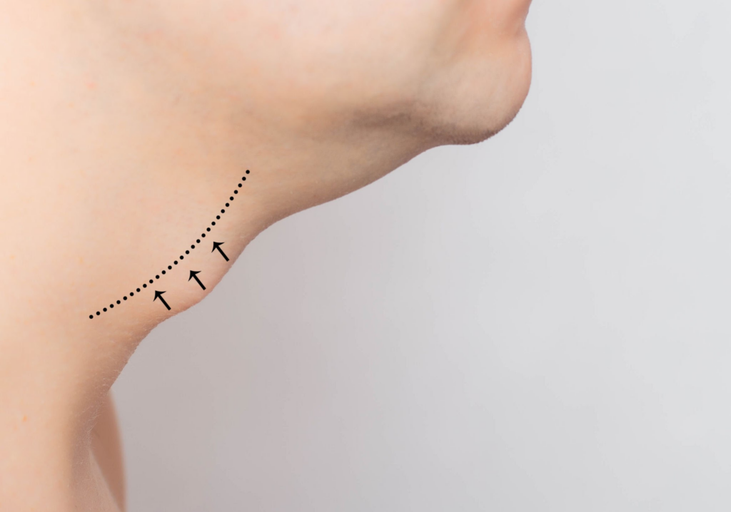 Quels sont les effets secondaires de la chirurgie de la pomme d'Adam ?