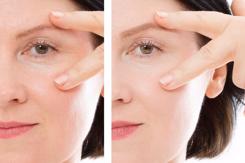 A close-up photo of a person's face with hands gently pulling back the skin around the eyes to demonstrate the effect of lifting or tightening the skin. The image is likely used to show before and after results of a skincare or cosmetic procedure.
