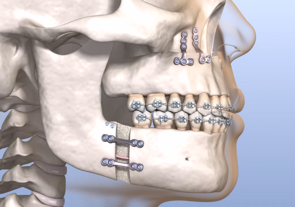 osteotomía