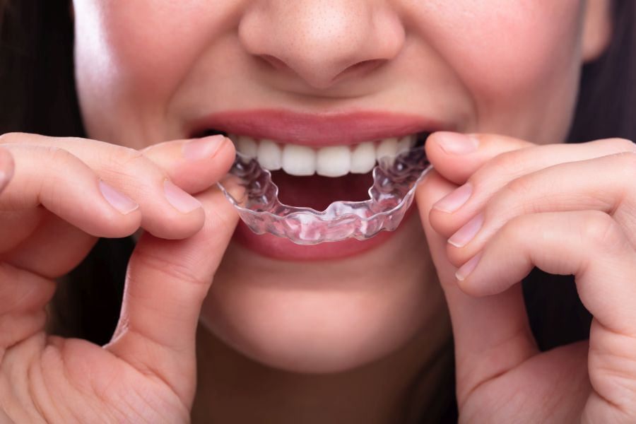 Unveiling the Secrets of Jaw Surgery: A Guide to Overbites and Underbites 2
