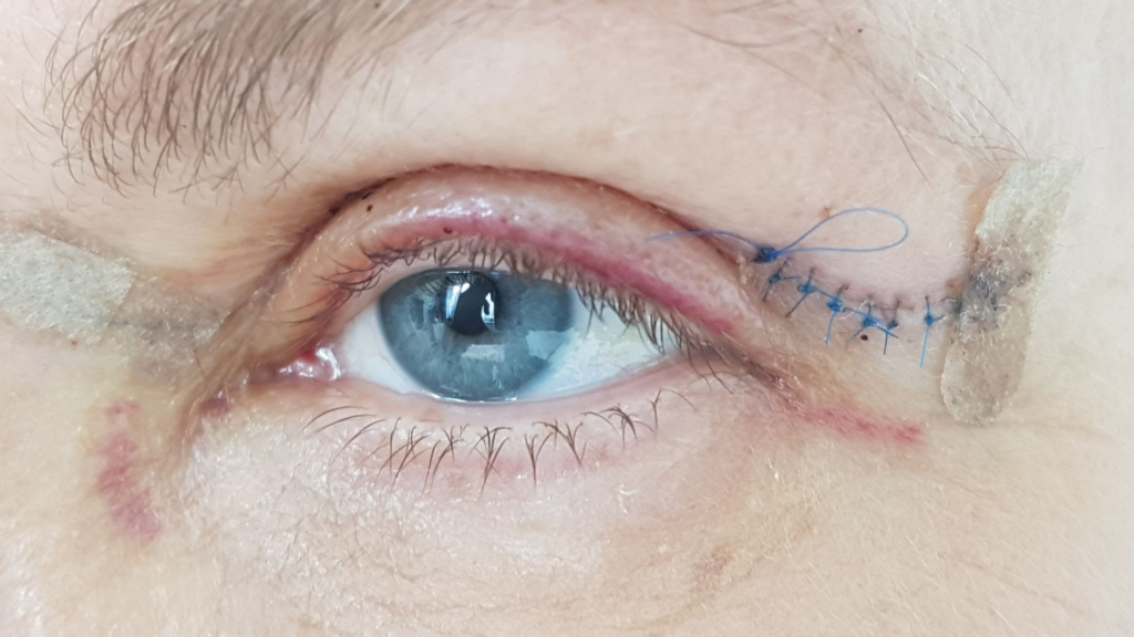 Augenlidretraktion nach Operation: Kann eine Canthal-Suspension helfen?