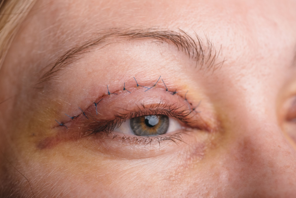 Augenlidretraktion nach Operation: Kann eine Canthal-Suspension helfen?