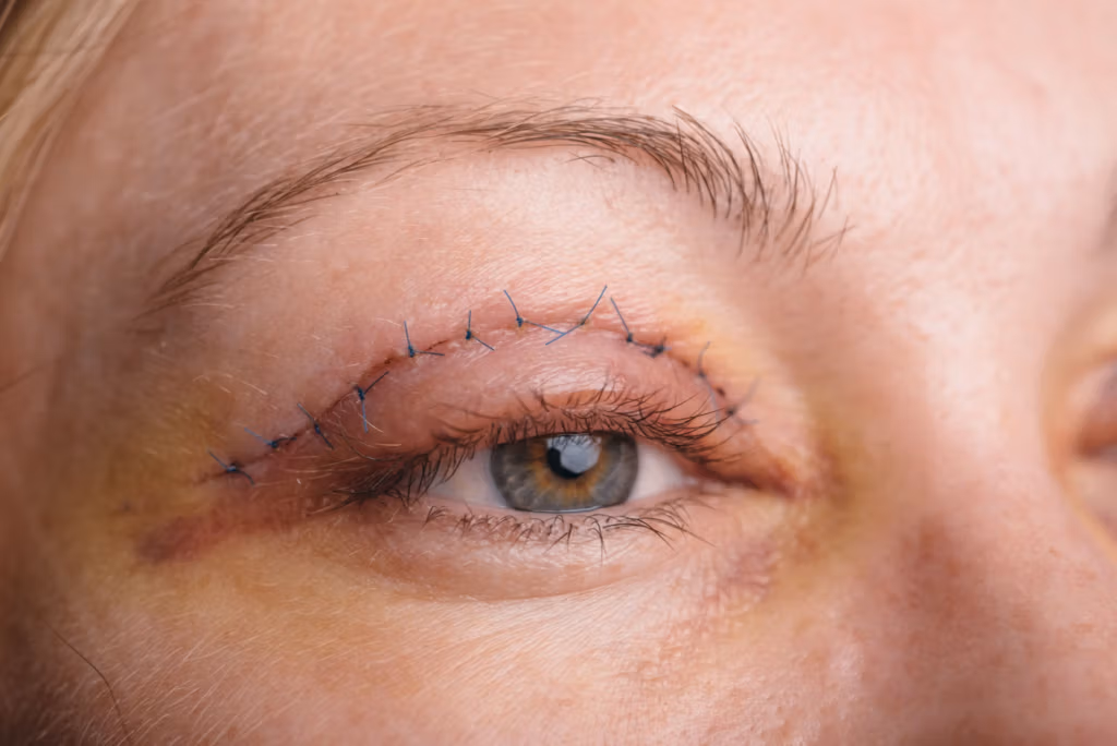 Imagen en primer plano del ojo de una persona con puntos de sutura visibles sobre el párpado, lo que indica una intervención quirúrgica reciente.