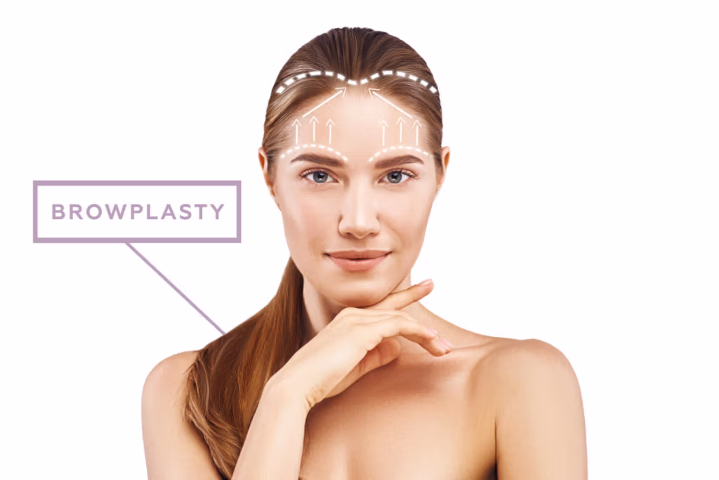 A woman with arrows pointing to her forehead, illustrating the areas affected by a browplasty procedure.