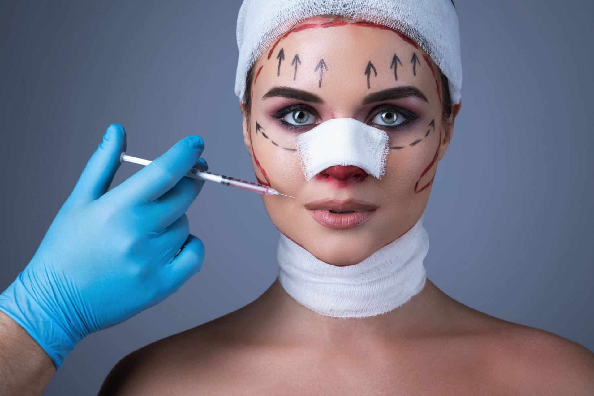 A person undergoing a cosmetic procedure with surgical markings on their face and a syringe being held near their cheek by a medical professional wearing blue gloves.